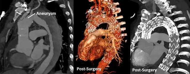 Patient scans of aortic aneurysms