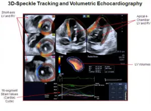 3d Speckle tracking